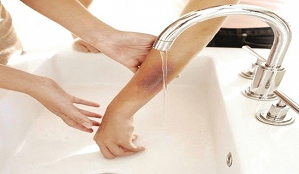 Mẹo chữa bỏng cho nhân viên bếp